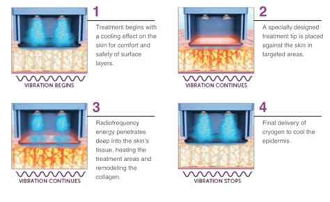 Thermage Skin Tightening Treatments Greenwich CT.